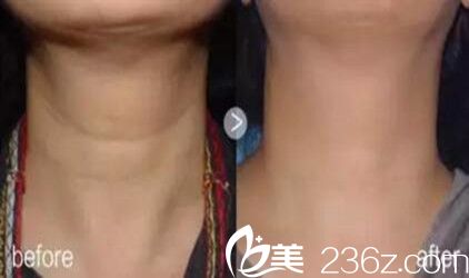 嗨體美頸針祛頸紋真人前后對比