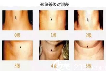 頸紋等級對照表