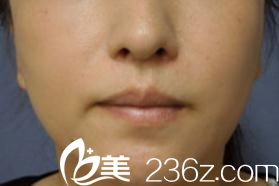 日本唇整形哪家醫(yī)院好?看我在橫濱ABE整形外科醫(yī)院找阿部圣孝做的櫻桃小嘴