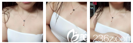 在無錫坤如瑪麗隆胸前平胸 在無錫坤如瑪麗隆胸前平胸