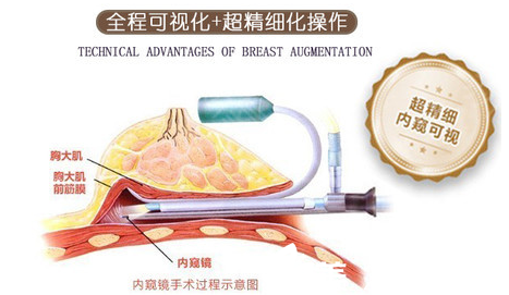 南寧韓成內(nèi)窺鏡豐胸