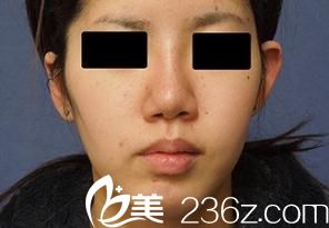 我來(lái)給大家反饋效果啦---10月份在在橫濱ABE整形外科醫(yī)院找阿部圣孝做的假體隆鼻現(xiàn)在美呆啦