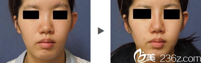 假體隆鼻前后對(duì)比