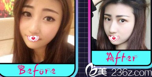 張曉亮院長做眼綜合案例 張曉亮院長做眼綜合案例