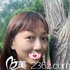 初次做雙眼皮失敗后來(lái)到邯鄲華美通過(guò)埋線雙眼皮修復(fù)術(shù)重現(xiàn)芭比大眼