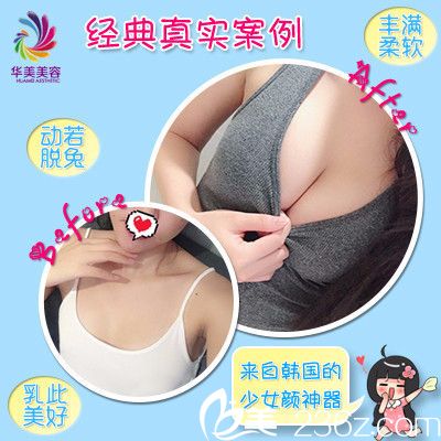 華美整形醫(yī)院做假體隆胸案例