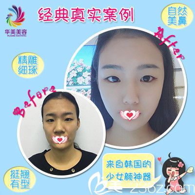 邯鄲華美整形醫(yī)院隆鼻前后對(duì)比