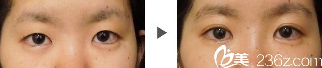 埋線雙眼皮前后對比