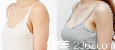 太原華美羅盛康隆胸失敗修復效果圖