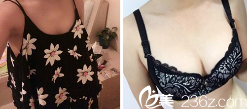 太原美媛薈整形隆胸前后對(duì)比圖 太原美媛薈整形隆胸前后對(duì)比圖