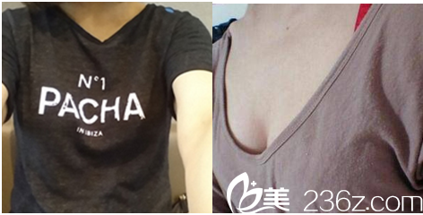 在北京美萊隆胸前樣子 在北京美萊隆胸前樣子