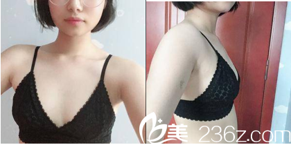 在北京美萊做脂肪豐胸前樣子 在北京美萊做脂肪豐胸前樣子