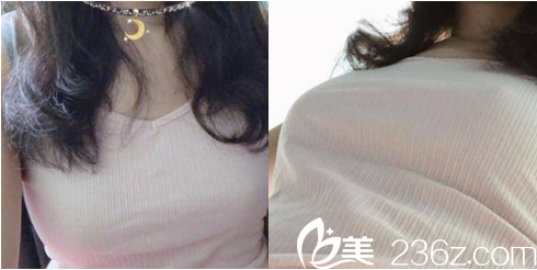 <!--<i data=20240703-sp></i>-->給我做脂肪豐胸第21天效果 <!--<i data=20240703-sp></i>-->給我做脂肪豐胸第21天效果