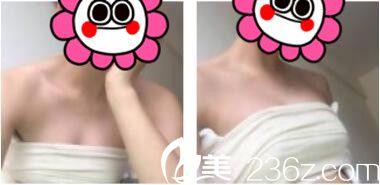 昆明韓辰醫(yī)療美容醫(yī)院胡喬假體隆胸真人案例術(shù)后第三天