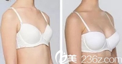黃吉波院長(zhǎng)胸部整形真人前后效果對(duì)比