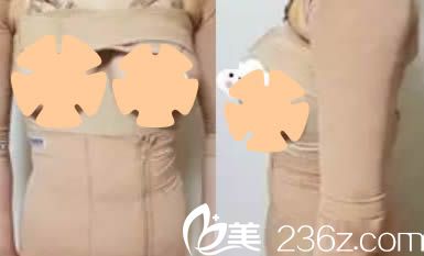 我在韓國珠兒麗腰腹吸脂和假體隆胸術后三天照 我在韓國珠兒麗腰腹吸脂和假體隆胸術后三天照