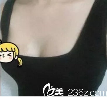 術(shù)后一周的效果 術(shù)后一周的效果