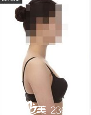 手術(shù)前照片 手術(shù)前照片