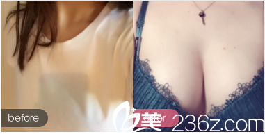 北京印正山鄭泰成隆胸案例 北京印正山鄭泰成隆胸案例