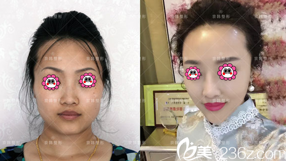 北京京韓喬愛生自體脂肪面部填充術(shù)前與術(shù)后對比效果案例