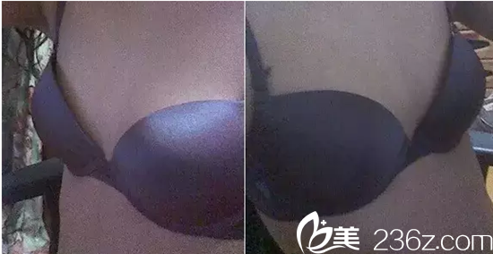 自體脂肪隆胸手術(shù)前照片 自體脂肪隆胸手術(shù)前照片