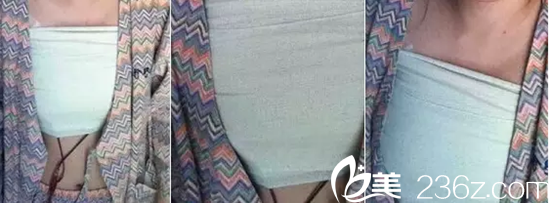 術(shù)后7天 術(shù)后7天