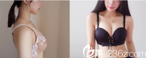 北京京韓王沛森脂肪豐胸案例 北京京韓王沛森脂肪豐胸案例