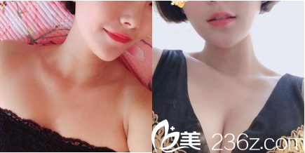 北京京韓自體脂肪豐胸案例