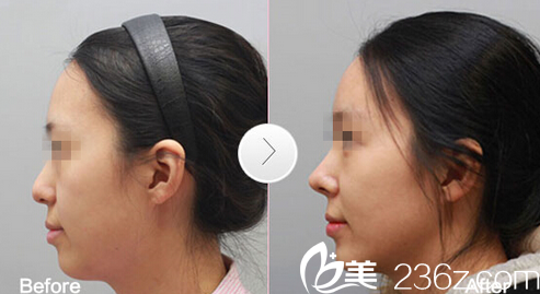 深圳福田軍科整形劉月更隆鼻子案例