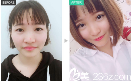 深圳福田軍科整形醫(yī)院2019年整形價(jià)格表 劉月更雙眼皮3800元,隆鼻16800元,隆胸8800元