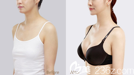 深圳軍科劉月更隆胸怎么樣