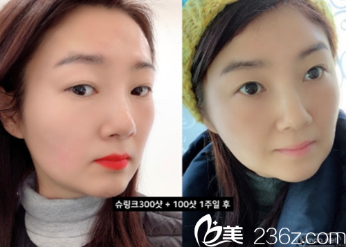 PPEUM醫(yī)院提升+瘦臉除皺