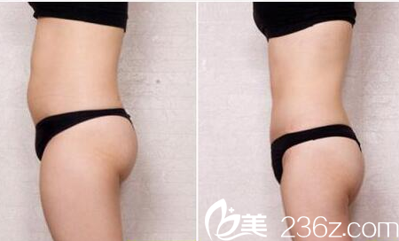 深圳軍科吸脂怎么樣