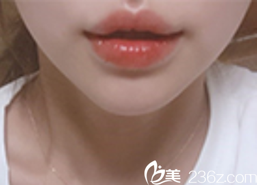 PPEUM醫(yī)院嘴唇填充