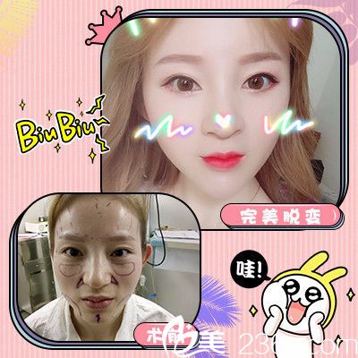 深圳軍科劉月更面部脂肪填充案例