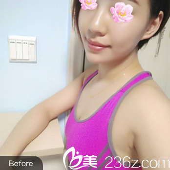 <!--<i data=20240703-sp></i>-->隆胸術(shù)前照片 <!--<i data=20240703-sp></i>-->隆胸術(shù)前照片