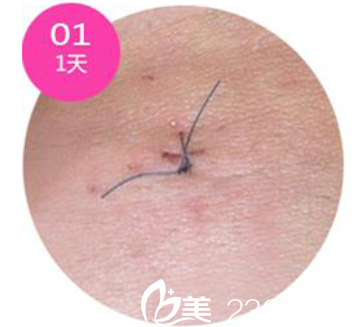 韓國(guó)安瑟林疤痕恢復(fù)天 韓國(guó)安瑟林疤痕恢復(fù)天