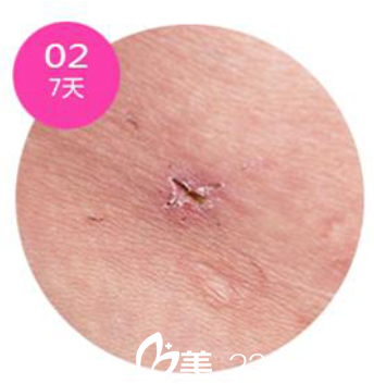 韓國(guó)安瑟林醫(yī)院疤痕恢復(fù)第7天 韓國(guó)安瑟林醫(yī)院疤痕恢復(fù)第7天