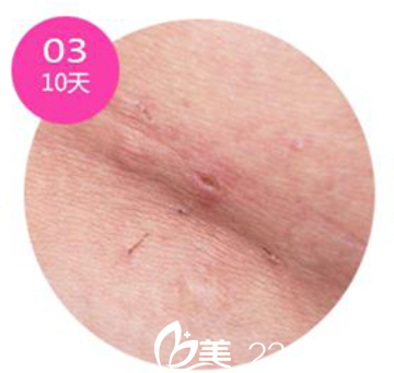韓國(guó)安瑟林醫(yī)院疤痕恢復(fù)第10天 韓國(guó)安瑟林醫(yī)院疤痕恢復(fù)第10天