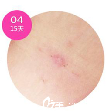 韓國(guó)安瑟林醫(yī)院疤痕恢復(fù)第15天 韓國(guó)安瑟林醫(yī)院疤痕恢復(fù)第15天