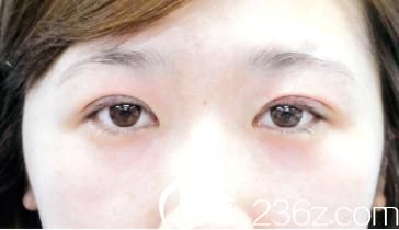 竹內(nèi)重夫埋線雙眼皮手術(shù)后當天照片 竹內(nèi)重夫埋線雙眼皮手術(shù)后當天照片