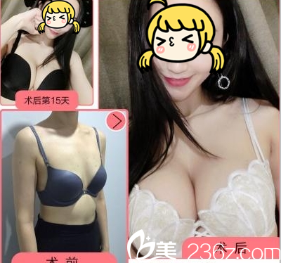 北京玲瓏梵宮自體脂肪豐胸特惠進(jìn)行中！王光輝自體脂肪豐胸12800元起附案例