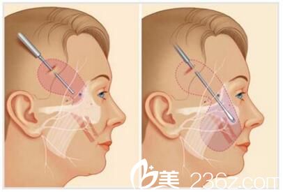 漯河締萊美面部線雕提升