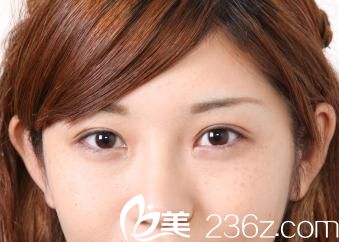 日本哪個(gè)醫(yī)生開眼角做的好?講講我在宇都宮醫(yī)院竹內(nèi)重夫醫(yī)生那里做的開內(nèi)眼角手術(shù)的親自經(jīng)歷