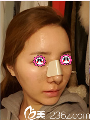 隆鼻后3天 隆鼻后3天