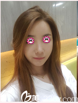 隆鼻兩個月后<span style= 隆鼻兩個月后<span style=