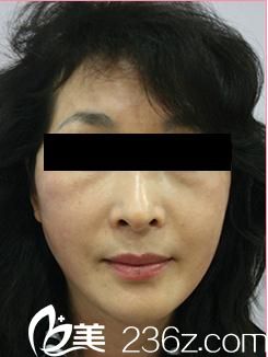 看日本有名的整形醫(yī)生中北信昭在自由之丘整形外科醫(yī)院為我做的奇跡線雕面部提升術(shù)