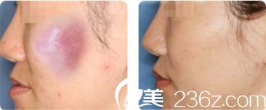 面部奧美定取出真人前后對(duì)比