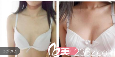 北京亞馨美萊塢自體脂肪豐胸優(yōu)惠活動(dòng)進(jìn)行中！自體脂肪隆胸9800元起