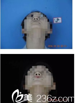 我做了隆鼻手術(shù)三個月的變化對比圖